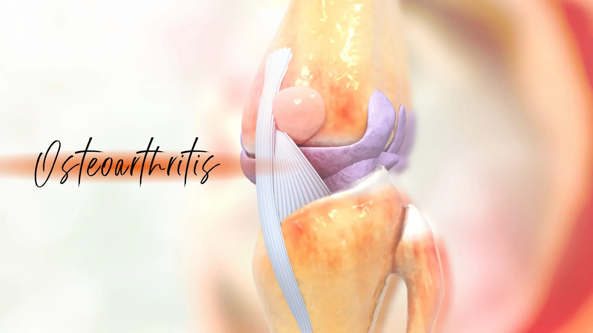 Osteoarthritis: Symptoms, Causes, and Holistic Treatments, image size:1920x1080