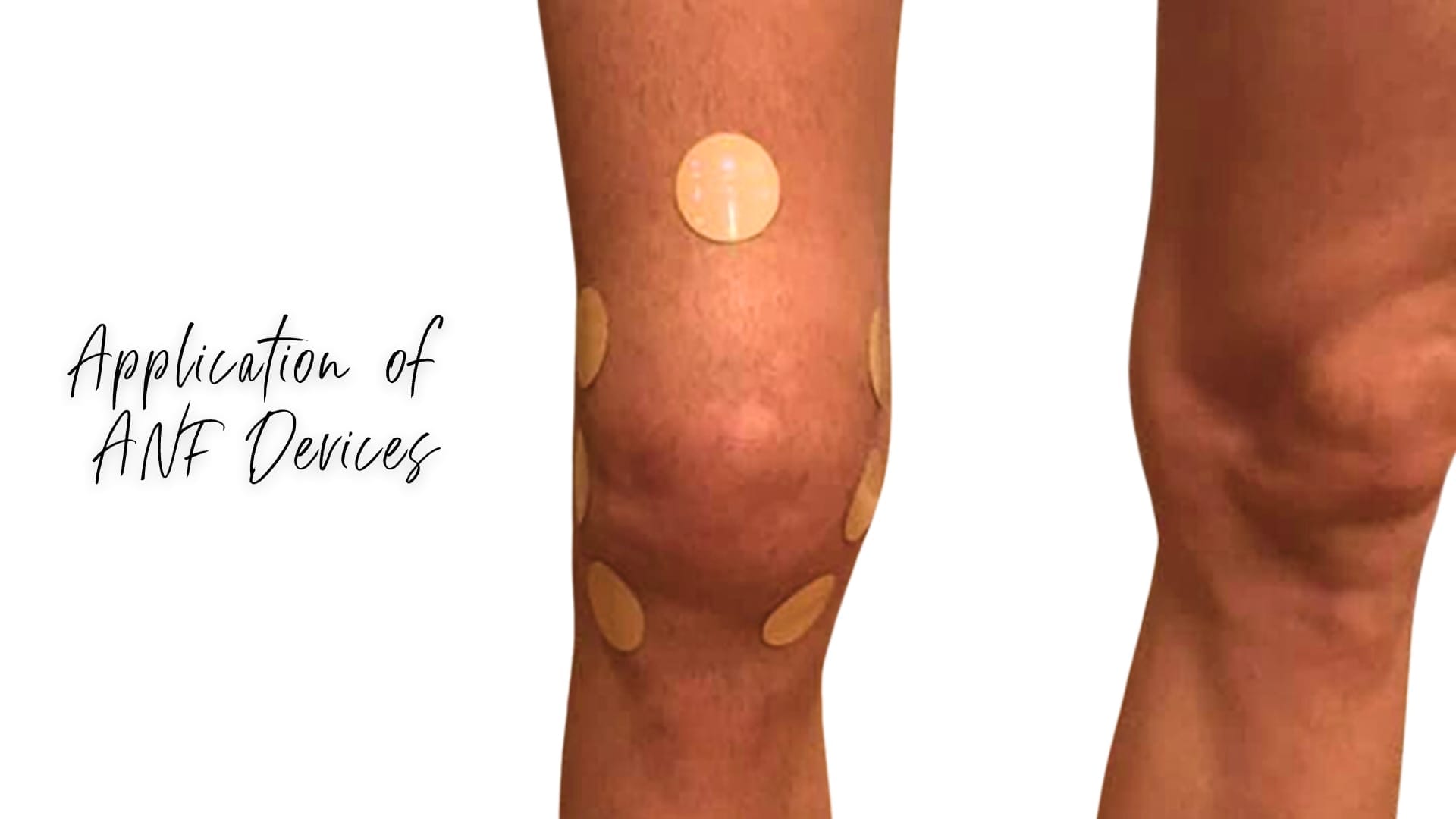 Knee Pain Application of ANF Devices