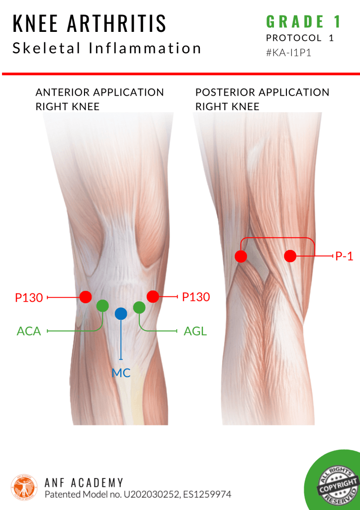 Knee Arthritis Skeletal Inflammation
