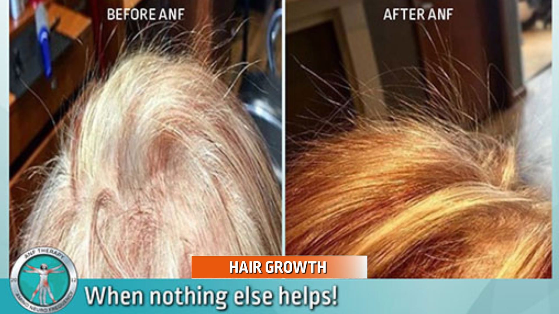 hair loss due to fibromyalgia