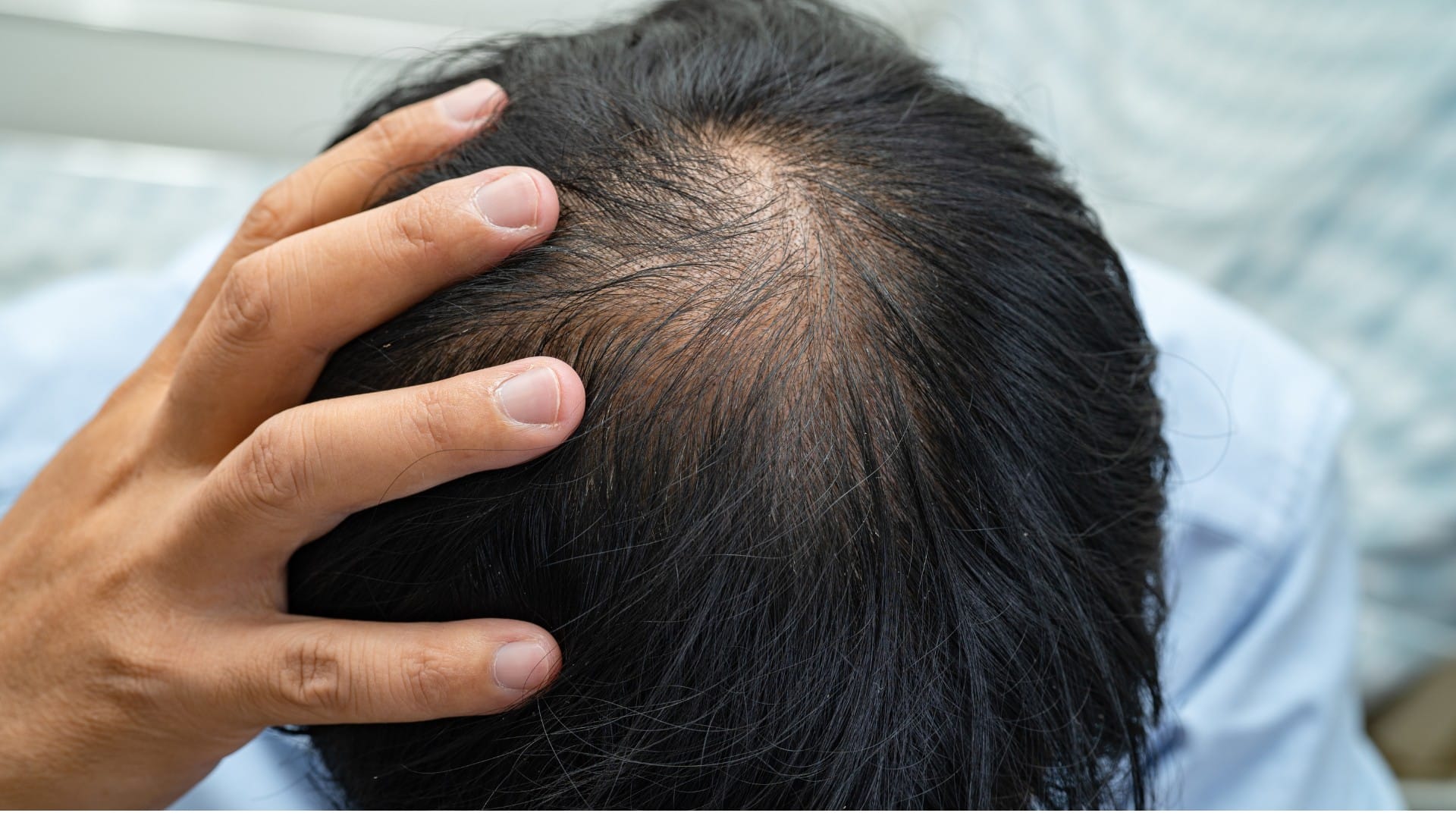 fibromyalgia cause hair loss